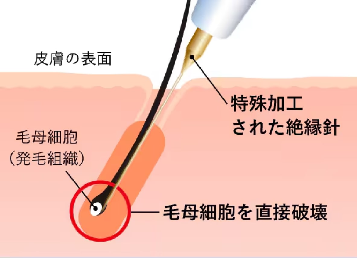 唯一の「永久脱毛」
