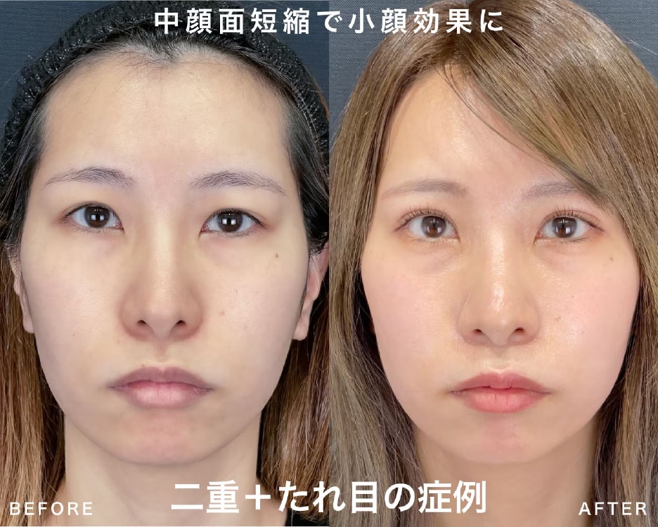 中顔面短縮効果あり