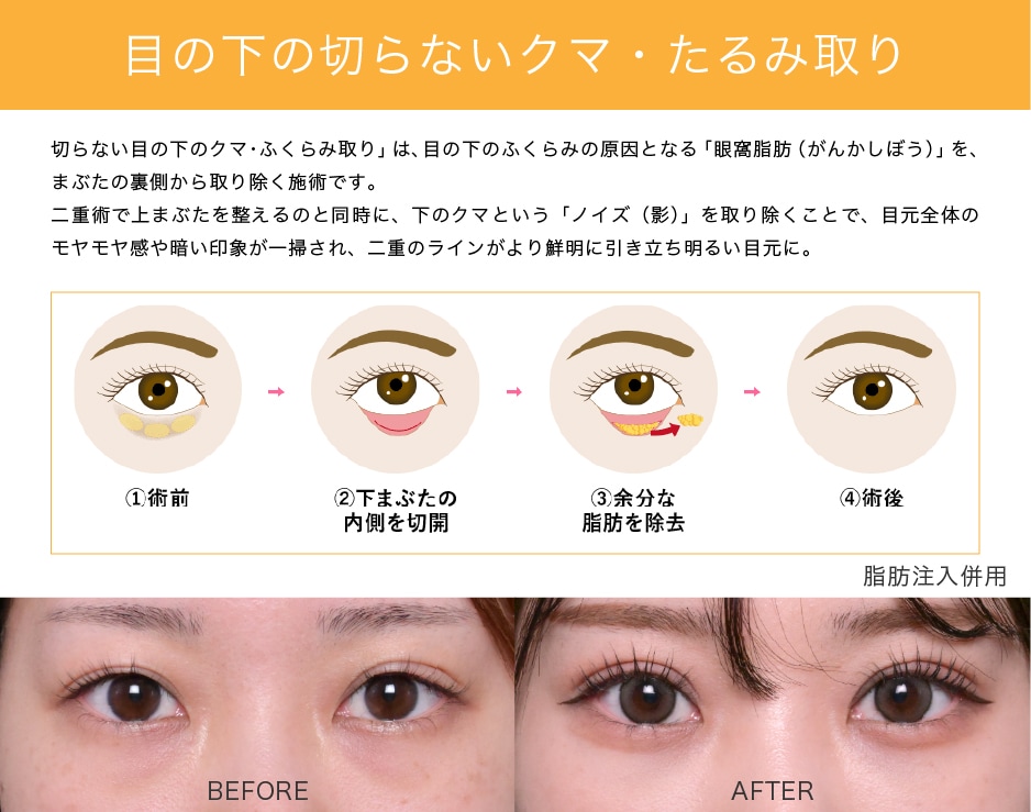 目の下の切らないクマ・たるみ取り