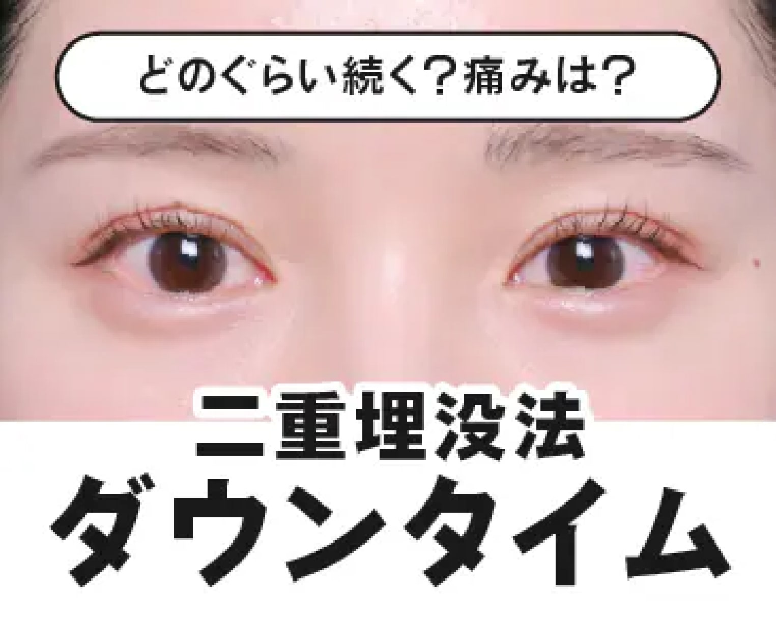 【二重埋没ダウンタイム】二重整形の経過紹介!腫れや内出血について徹底解説!【湘南美容クリニック大宮東口院】