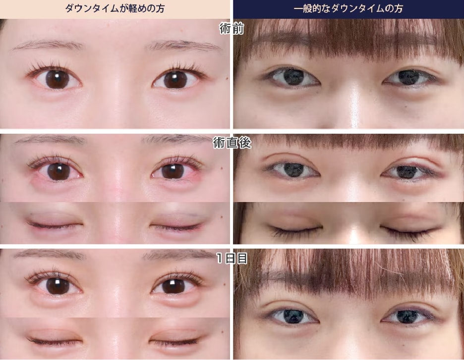 直後〜1日目：腫れや内出血の出はじめ