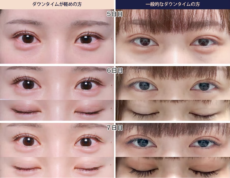 4日目~7日目：自然な目元に