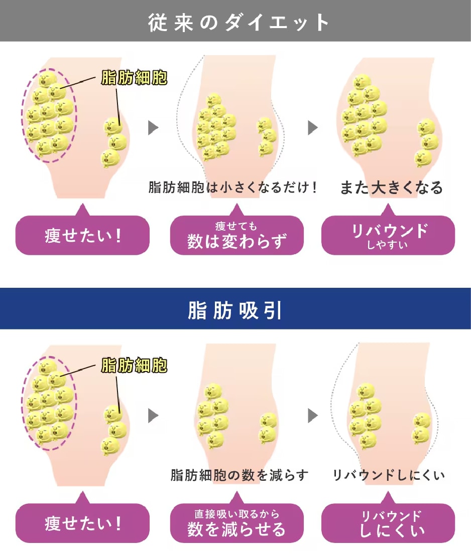 脂肪吸引の仕組み