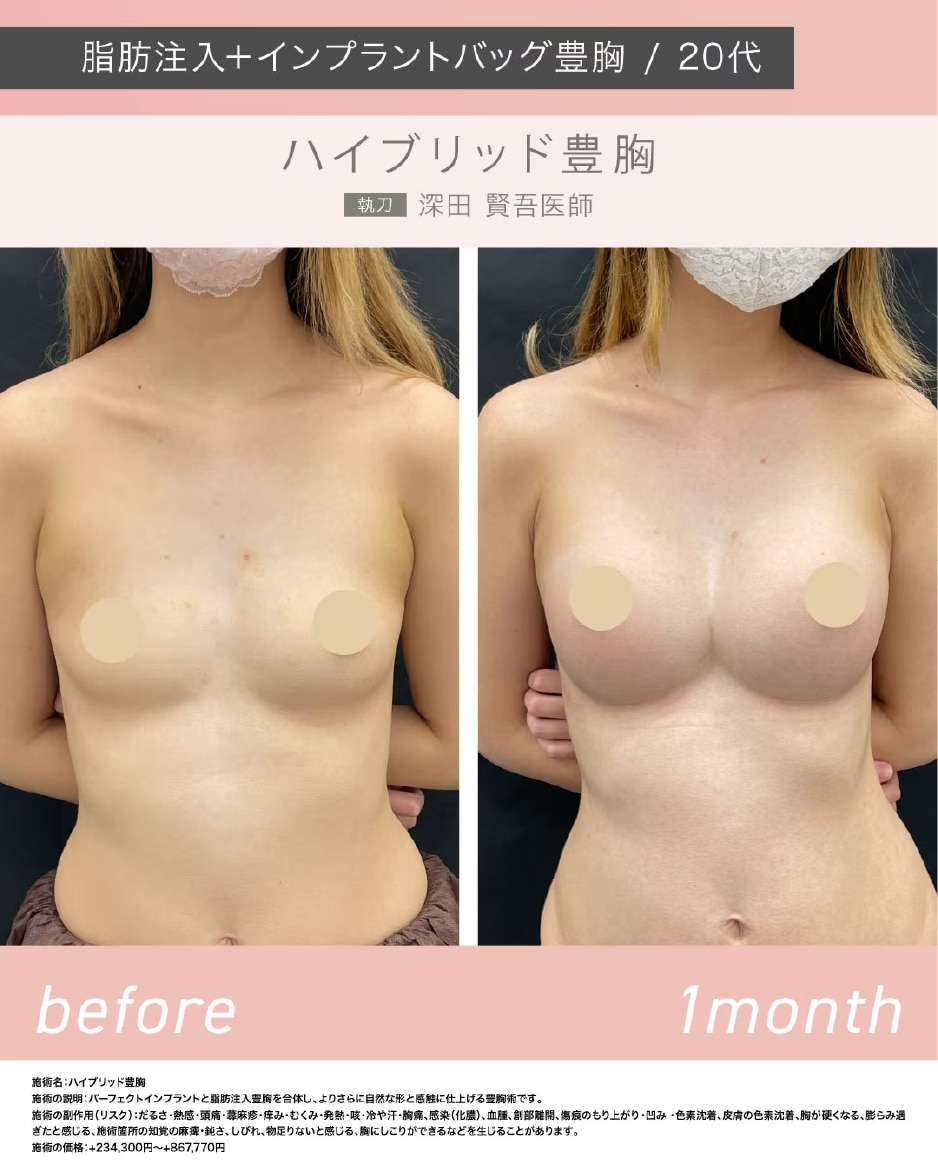 【ハイブリッド豊胸】脂肪注入＋バッグ豊胸で思い通りに形・大きさに