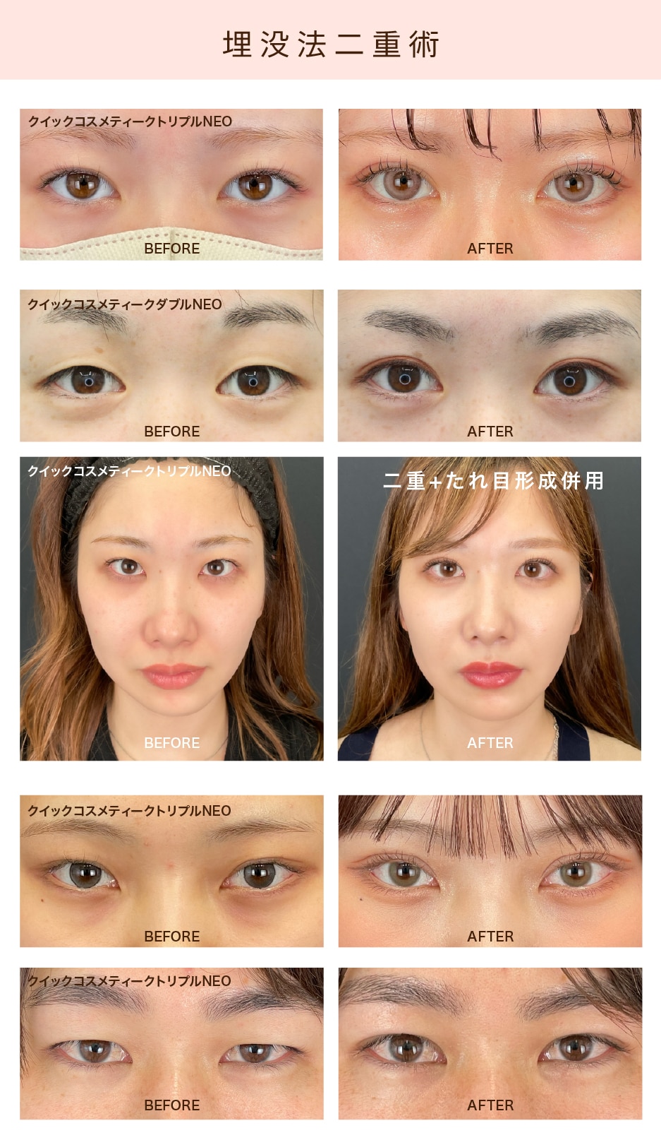 深田院長の二重症例