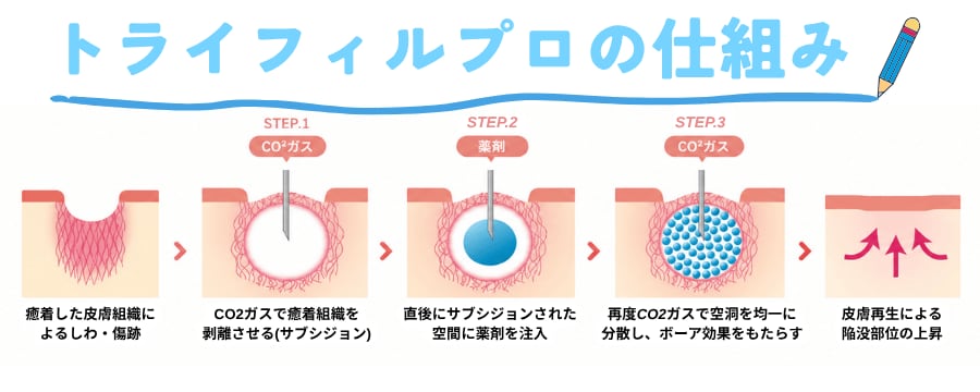 トライフィルプロCO2ガス×薬剤注入のWアクションが生み出す仕組み