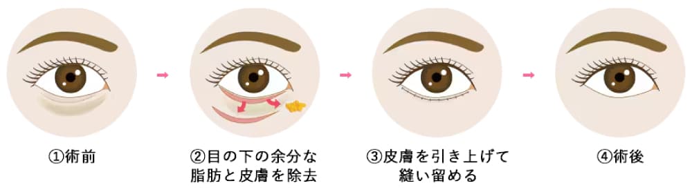アイバックリムーブ