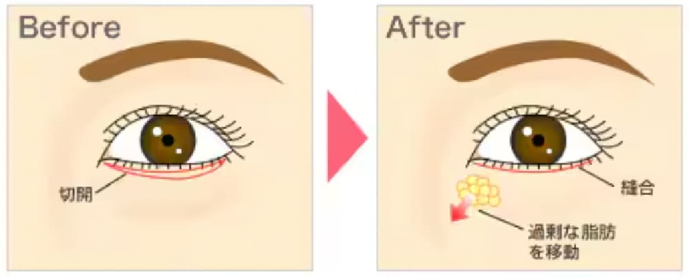 切開ハムラ