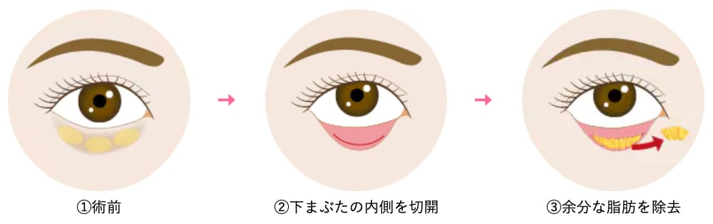目の下の切らないクマ取り（脱脂）