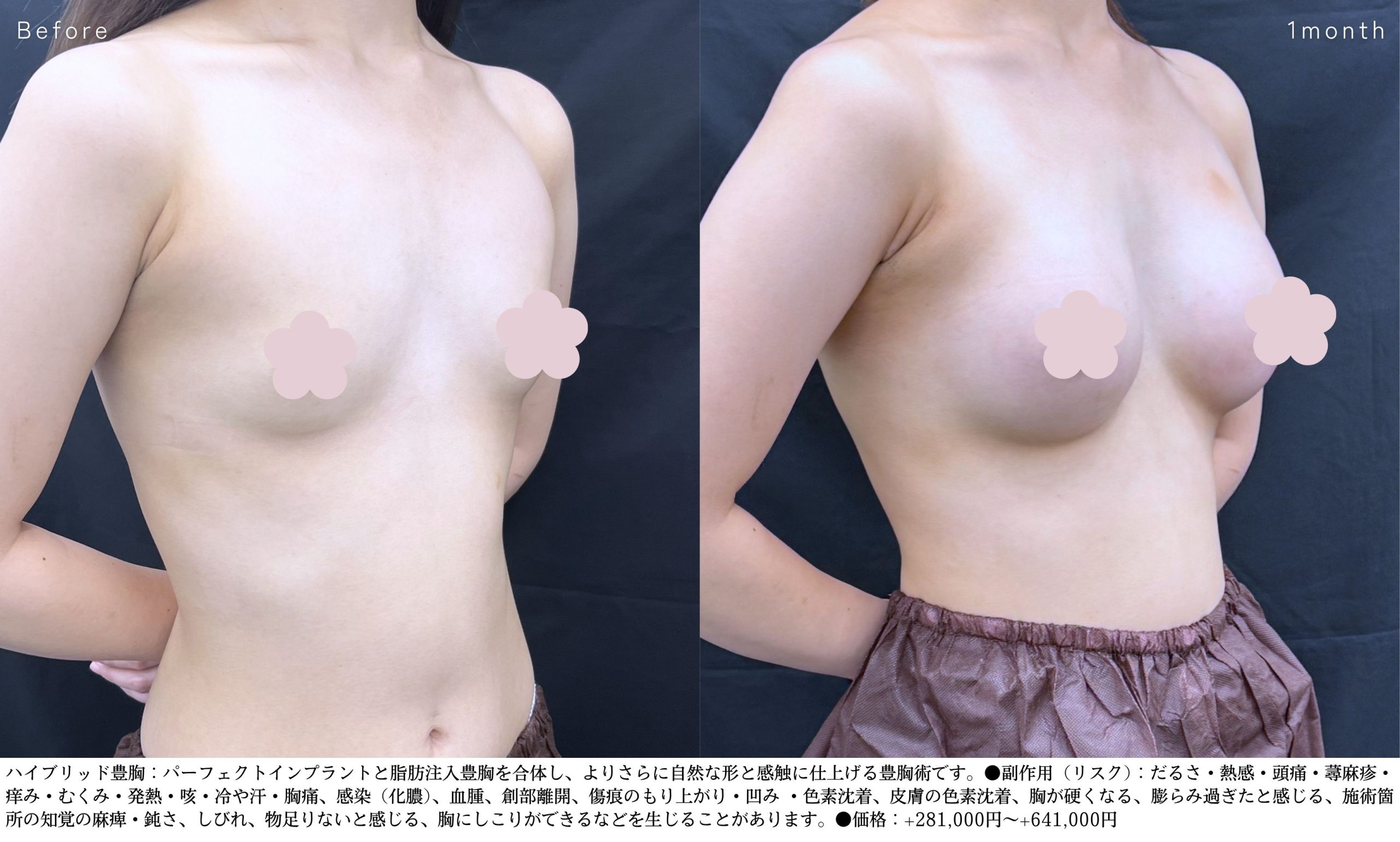 豊胸症例