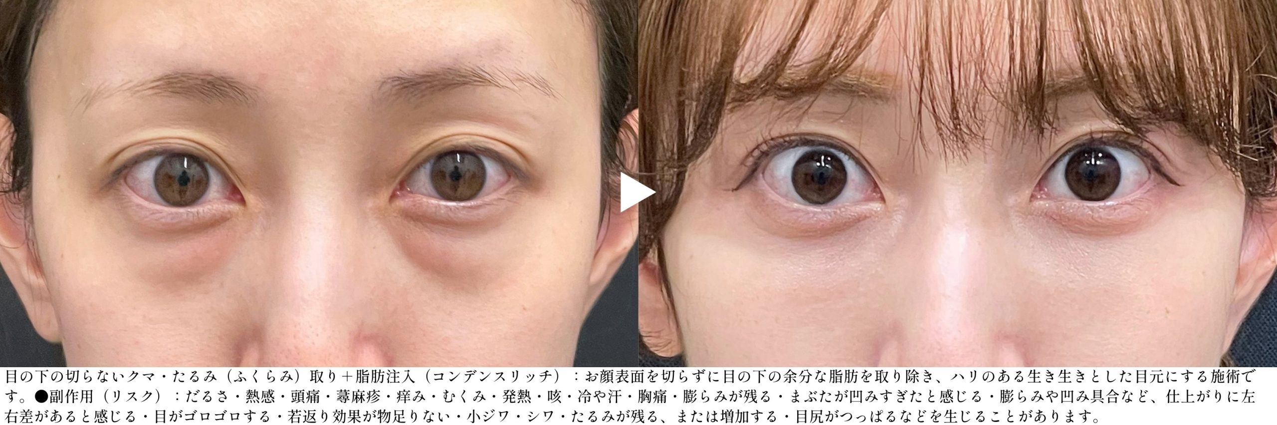 くま取り症例