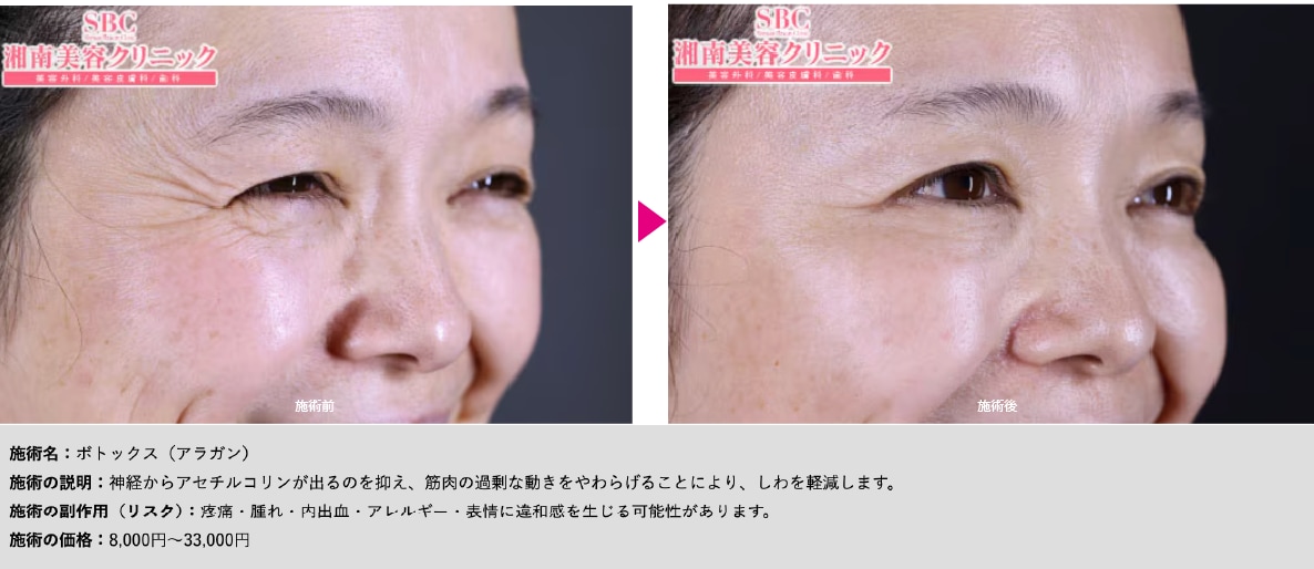 笑った時の“オバ見え”に悩んでいる方必見
