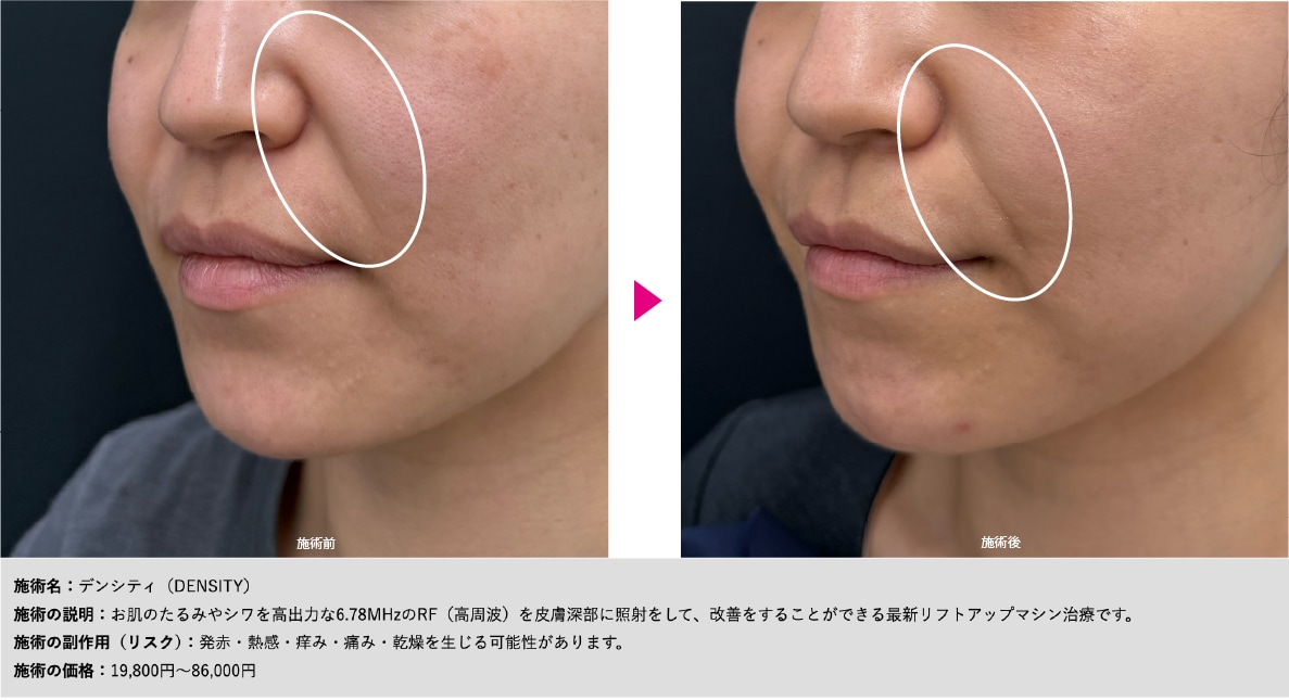 ほうれい線のケア今から始めませんか？