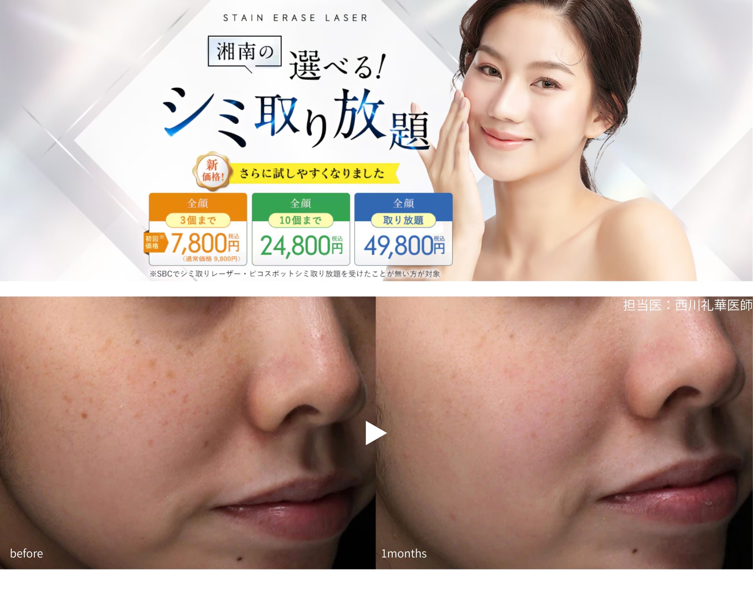 シミ取りレーザー