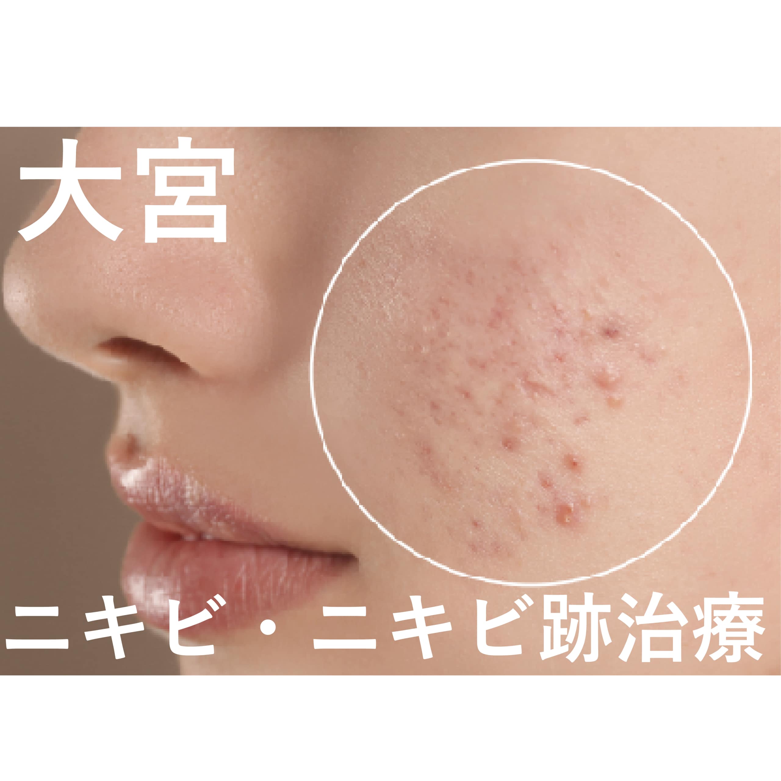 【2026年最新版】大宮でできる「ニキビ」・「ニキビ跡」におすすめな施術を紹介！