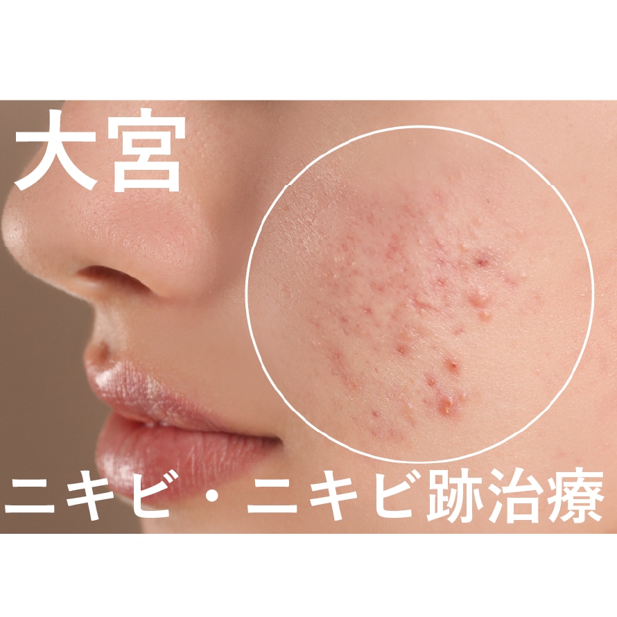 【2026年最新版】大宮でできる「ニキビ」・「ニキビ跡」におすすめな施術を紹介！