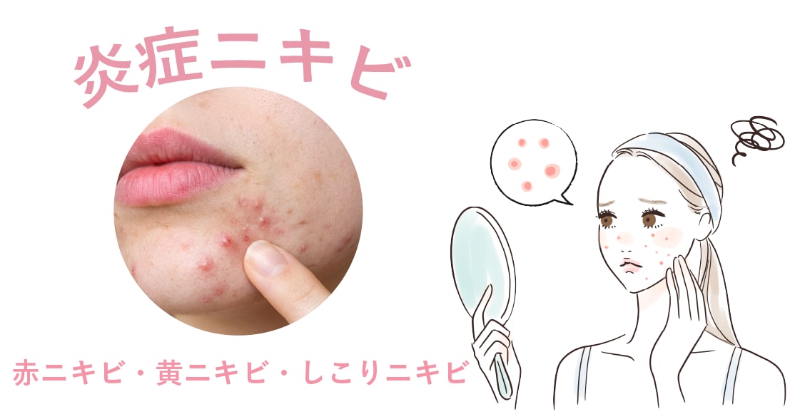 炎症性ニキビの種類
