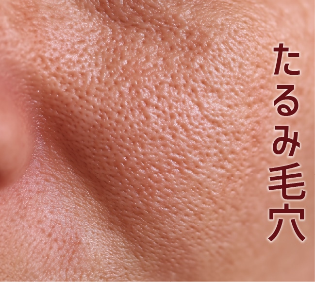 たるみ毛穴(帯状毛穴)