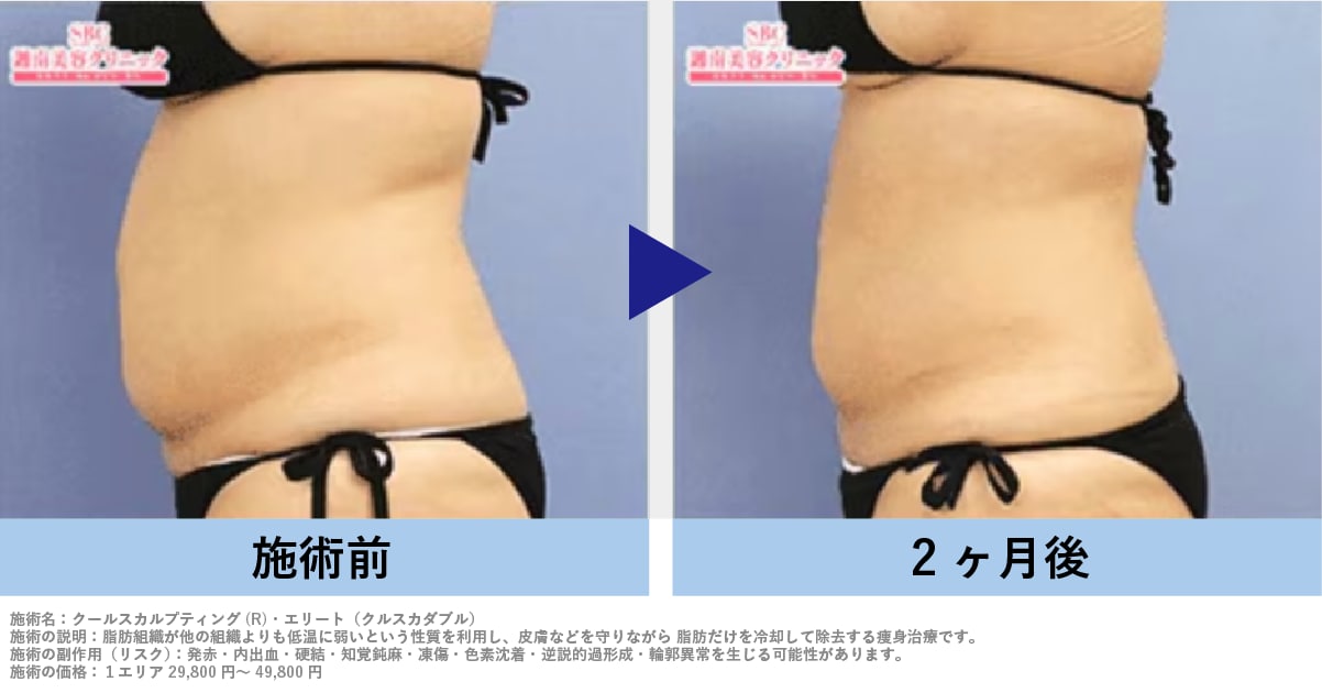 クールスカルプティング