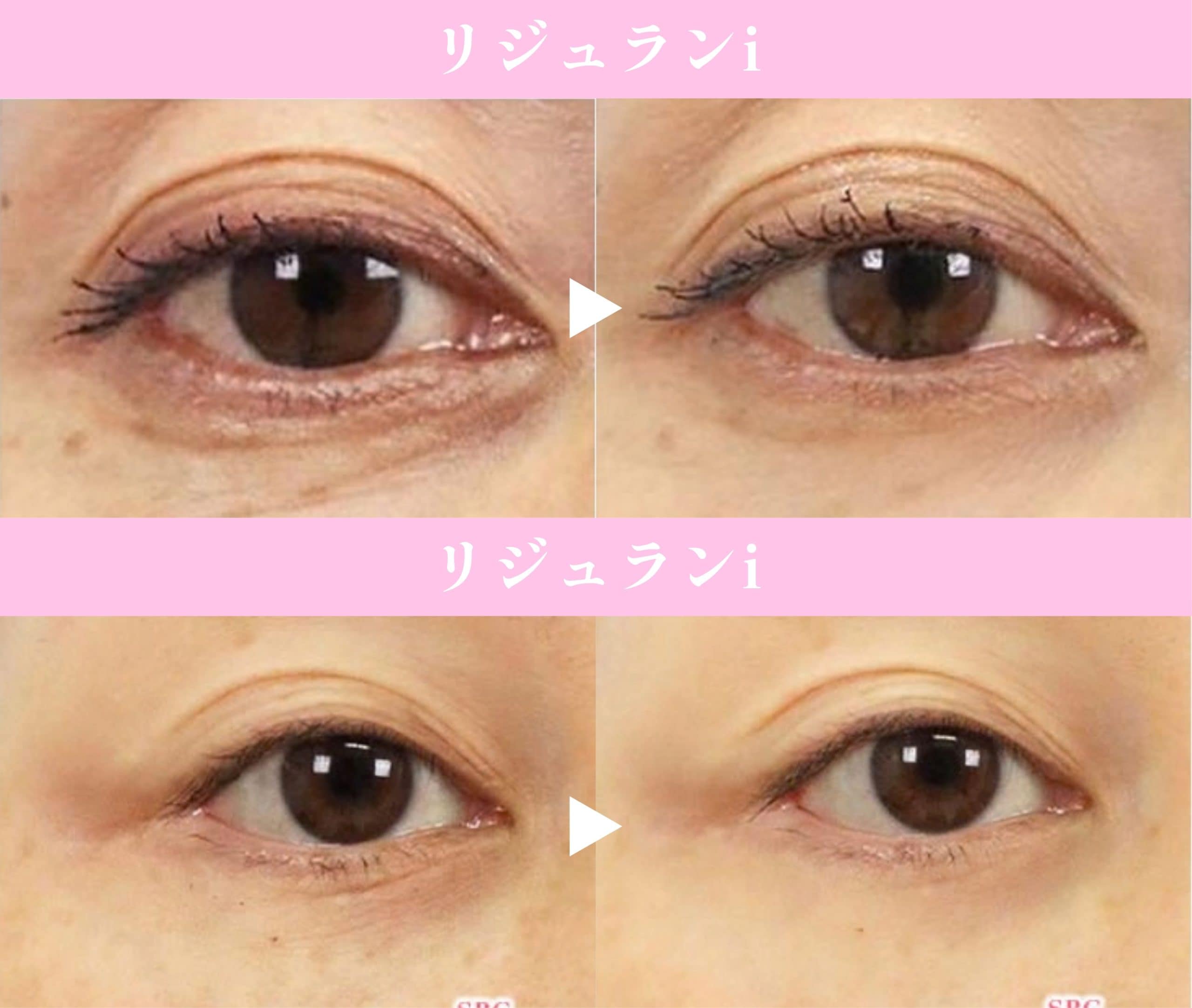 リジュランの症例写真をチェック！