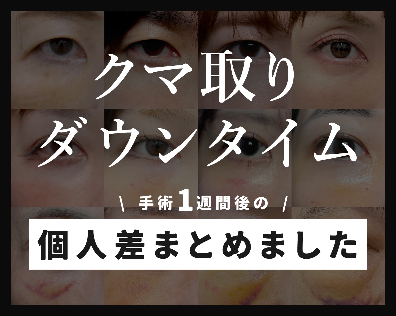 【クマ取りのダウンタイム】症例写真で見る個人差とリアルな経過