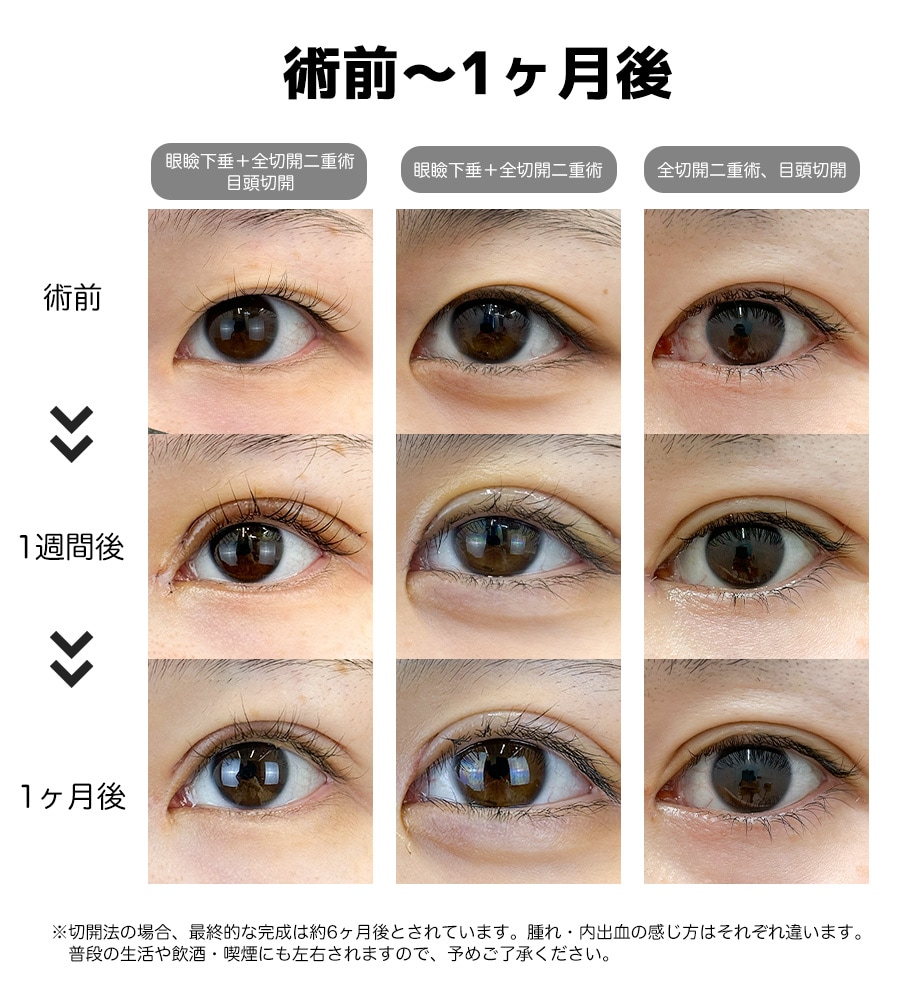 1週間後はどれくらい腫れる？