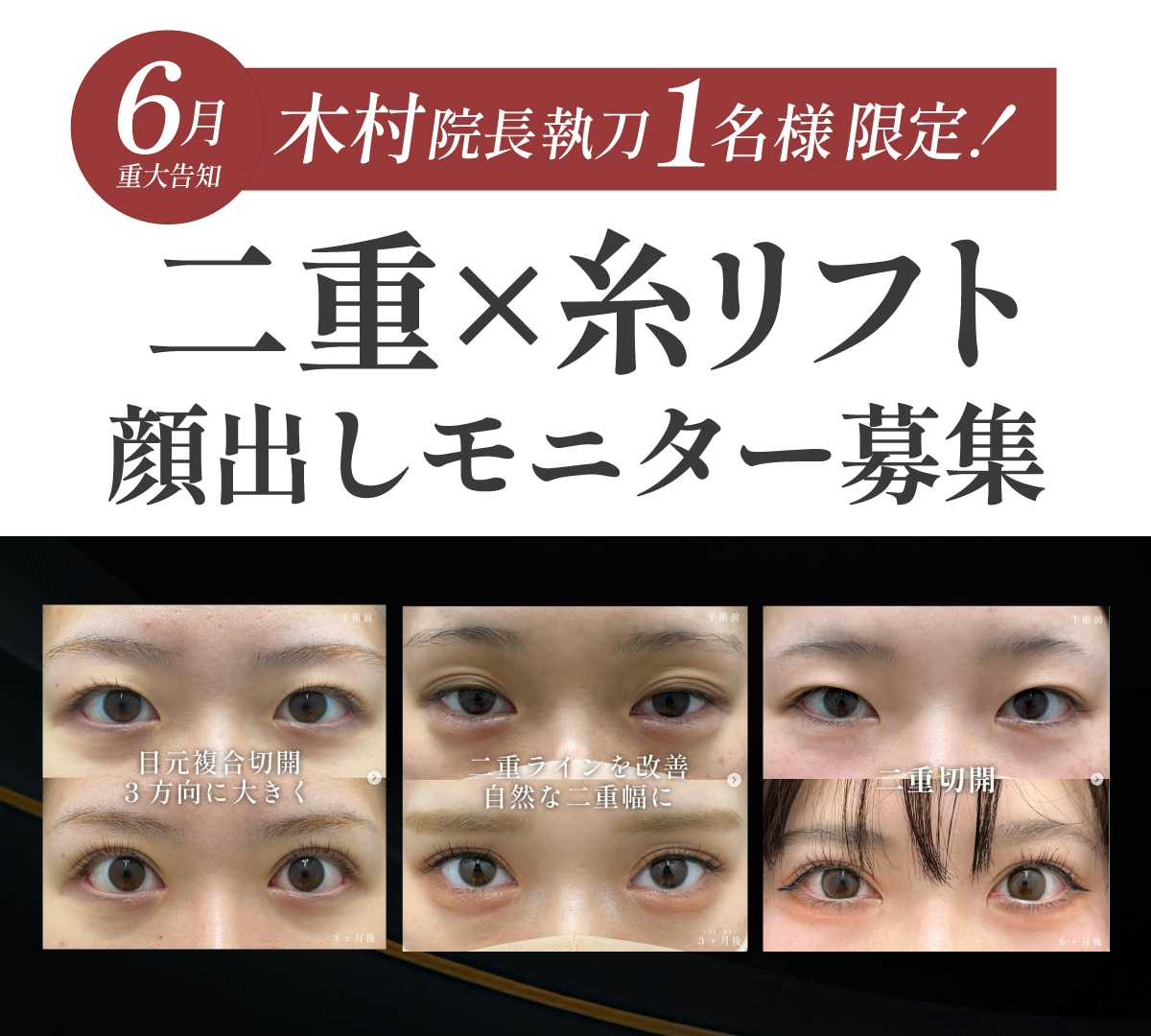 二重＆糸リフト同時顔出しモニター募集！限定1名様！