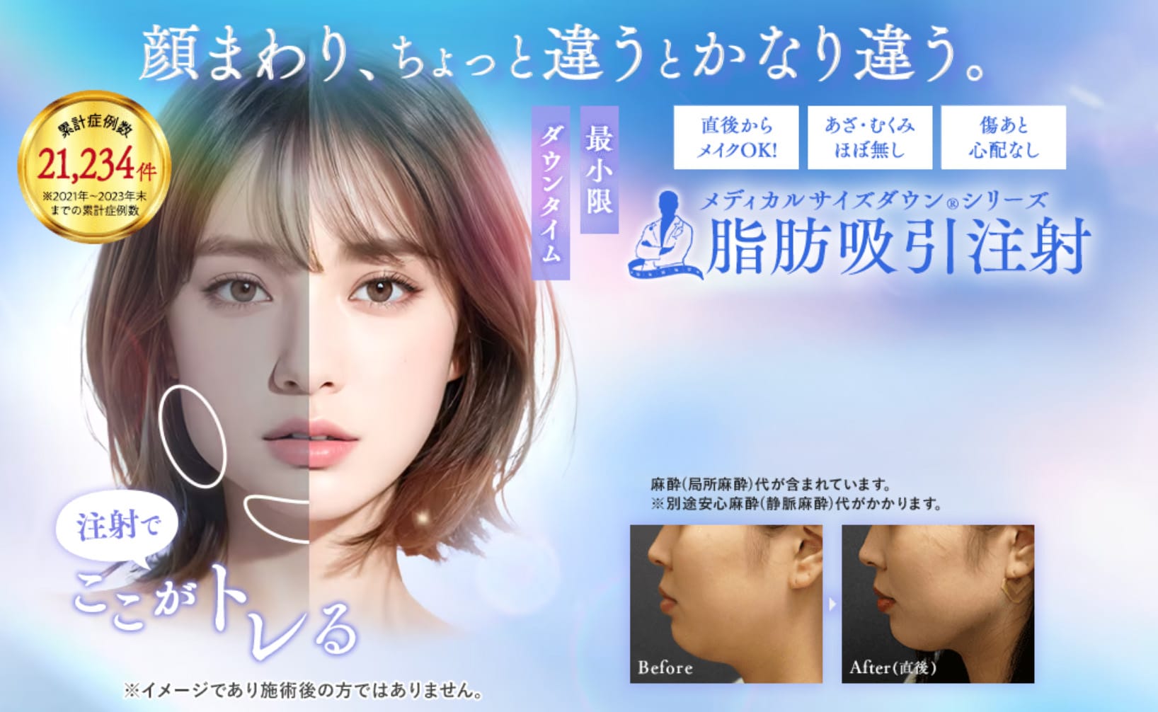 安全・確実・簡単な部分やせ術【脂肪吸引注射】