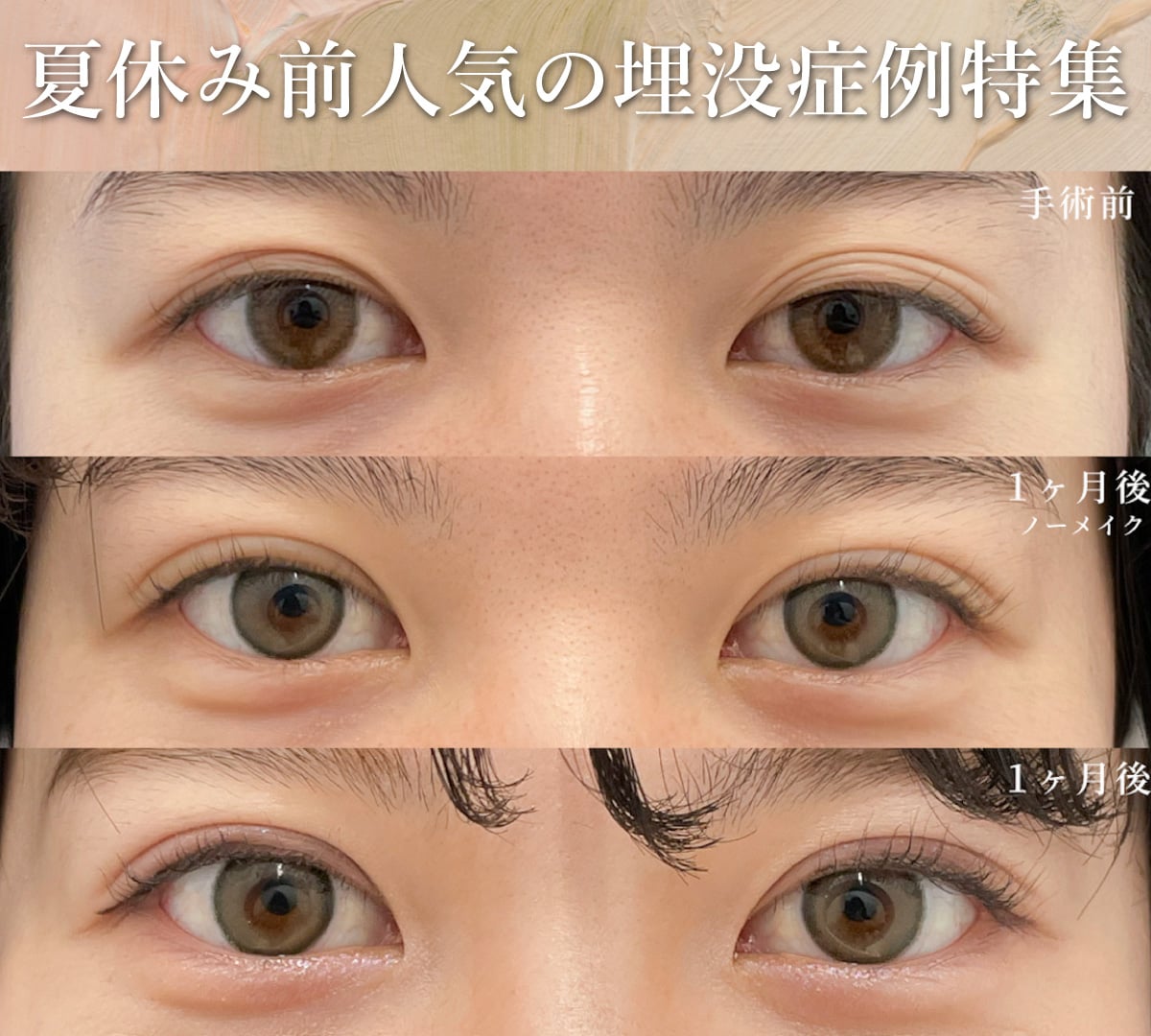 【二重埋没法人気症例特集】夏休み・お盆に埋没したいあなたへ