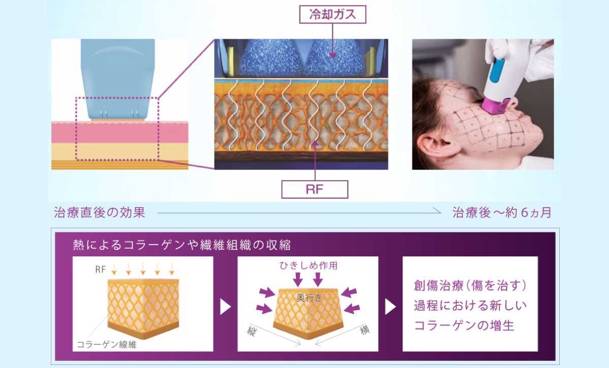 たるみ治療の王道【サーマクールの特徴・サーマクールって？】
