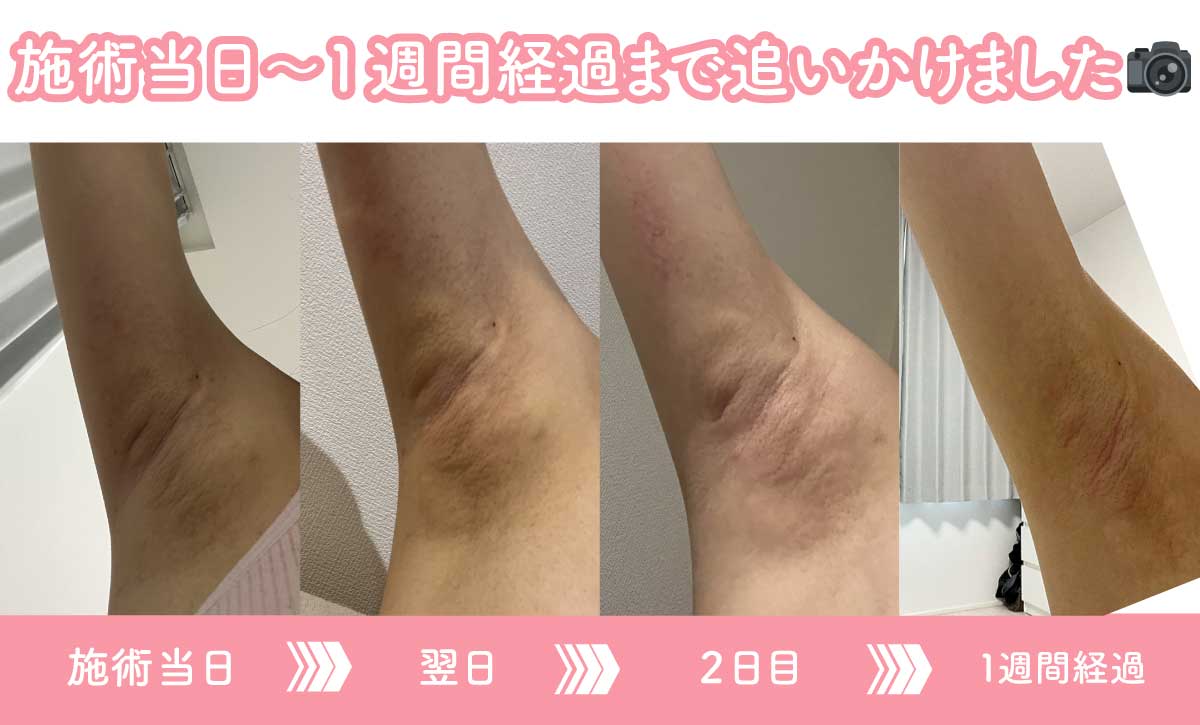 受付さんダウンタイム経過レポ