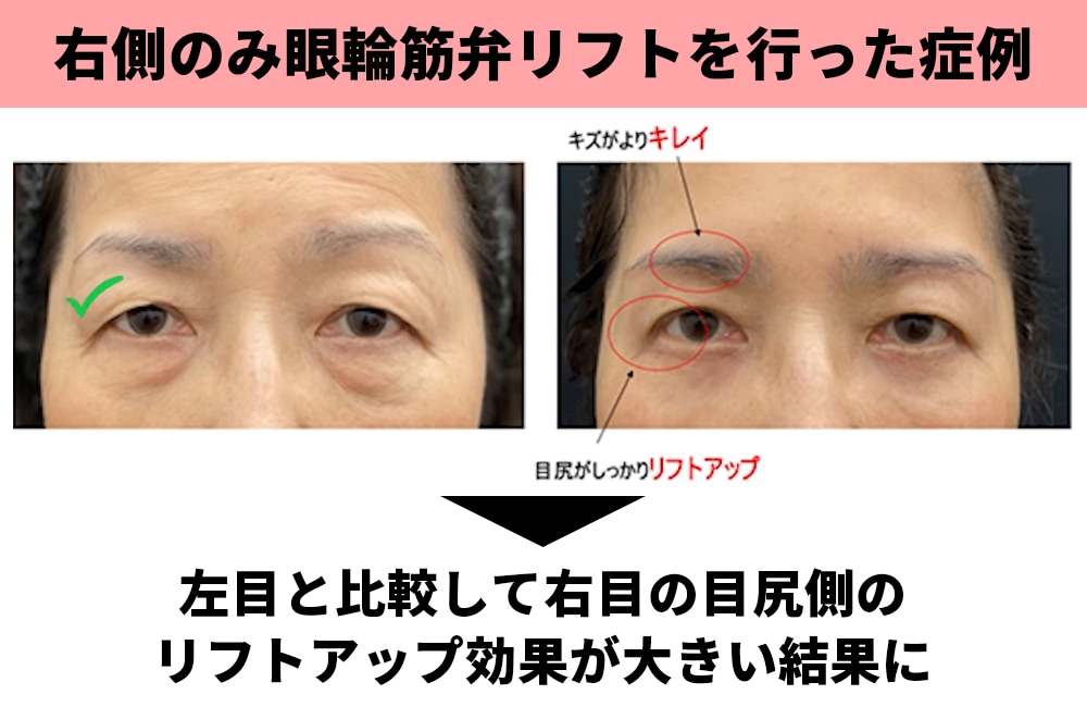 検証②左右で施術方法を変えた場合の効果・傷跡の差はあるか