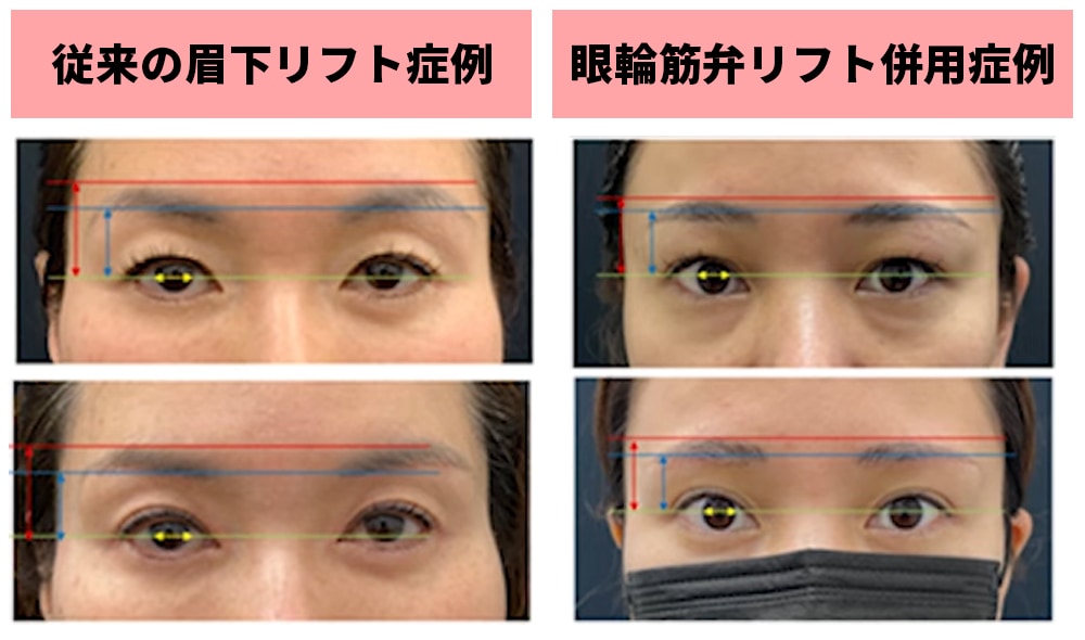 検証①眉毛の位置は変化するかどうか