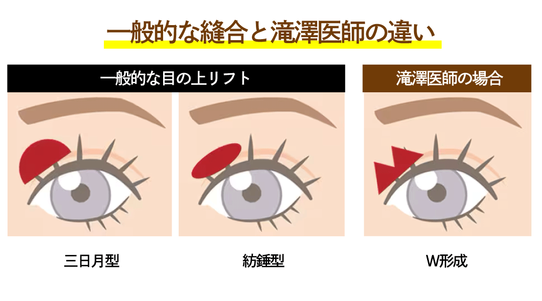 滝澤医師だからこそできるW形成法で行う目の上リフト