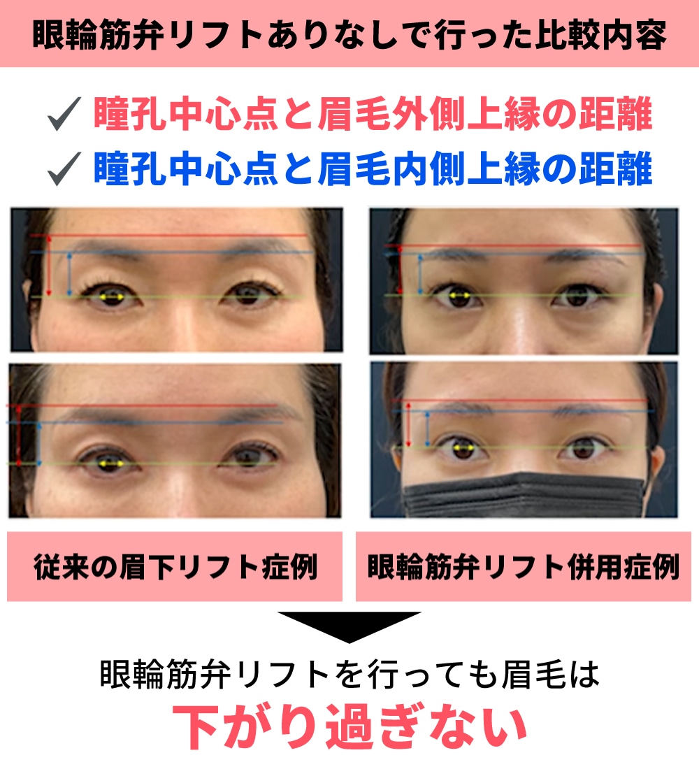 検証①の結果：眼輪筋弁リフト併用でも眉毛は下がりすぎない