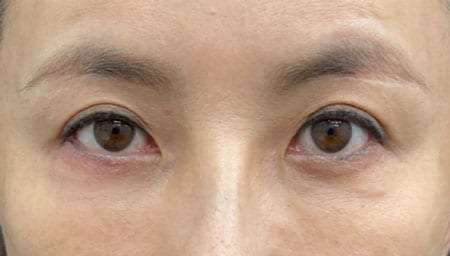 眉下リフト後、ツリ目っぽくなってしまった