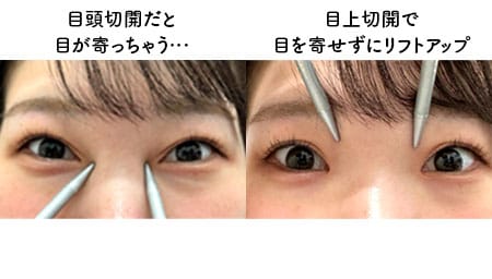 目を寄せずにまぶた内側のタルミを解消したい方