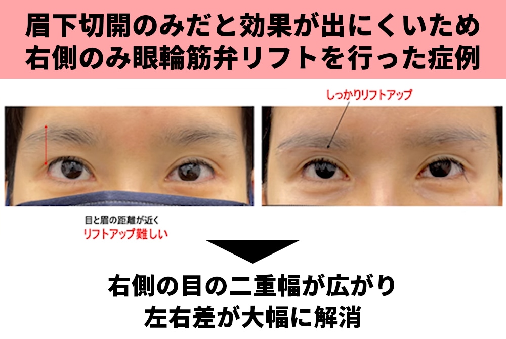 検証③通常の眉下切開で効果が出にくい場合