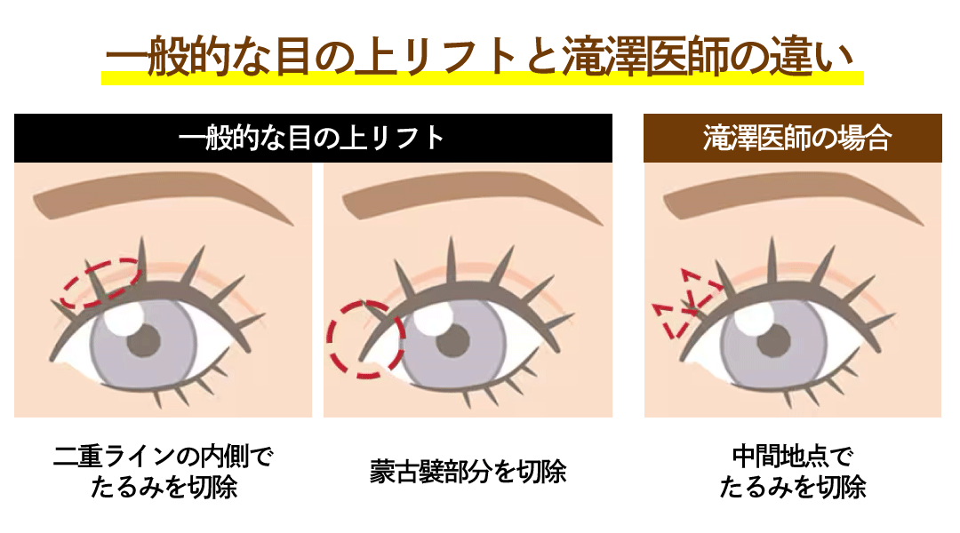 滝澤医師の目の上リフトは切除位置が違う
