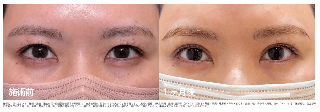 【20代女性】目の上リフト+クイックコスメティークダブル　術後1ヶ月後