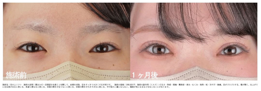 【20代女性】目の上リフト+切開法眼瞼下垂　術後1ヶ月後