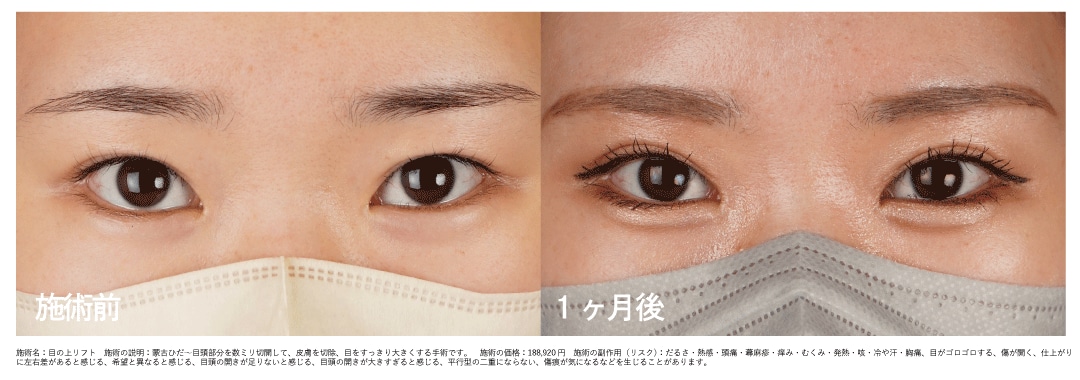 【20代女性】目の上リフト+眉下リフト+眼輪筋弁リフト　1ヶ月後