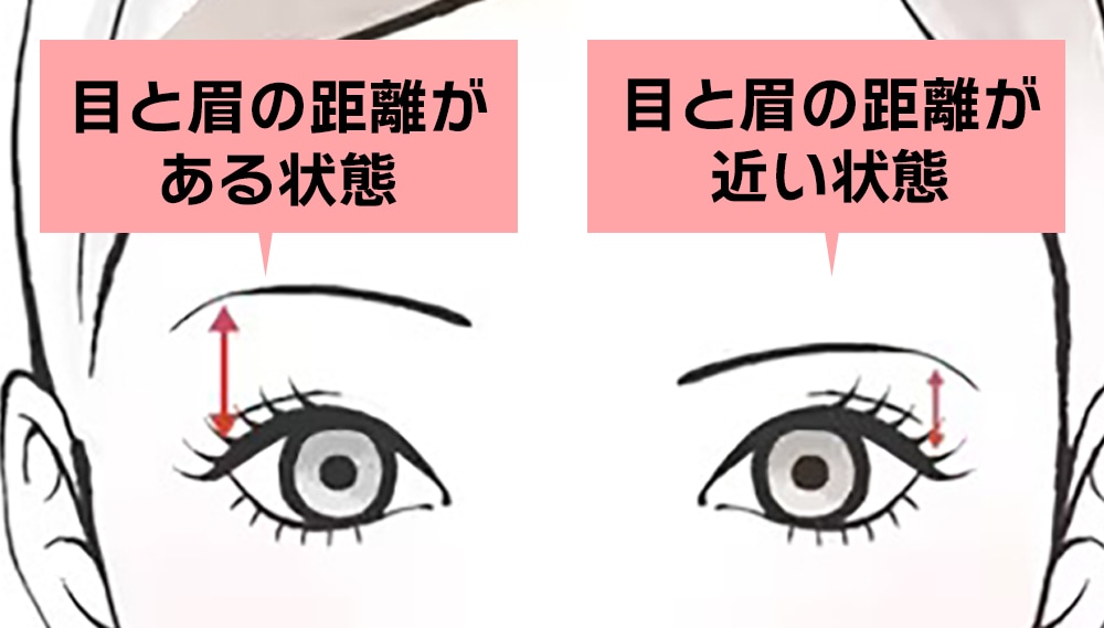 眉下切開の課題①目と眉の距離が近い場合