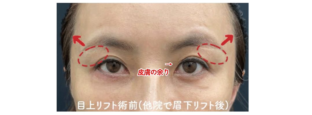 外側が引き上がることによる「目頭側の被さり」が原因