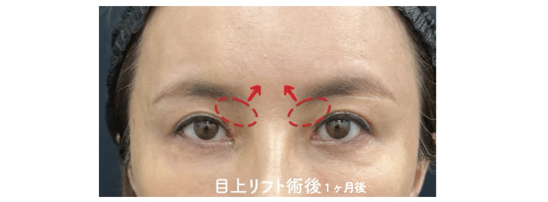 目の上リフトで叶える「優しいアーチ型」の並行二重
