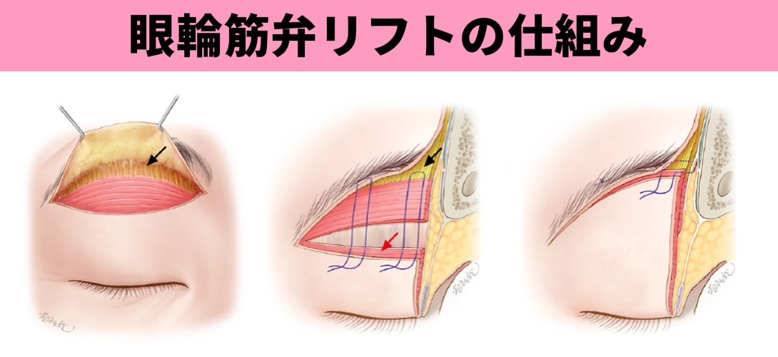 眼輪筋弁リフトの仕組み