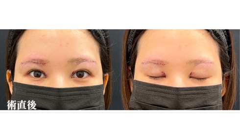 術直後<br />
