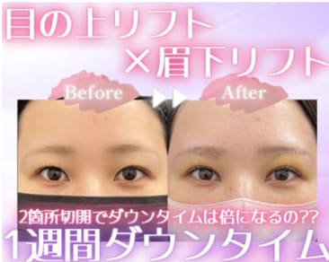 【目の上リフト×眉下リフト】一緒にやりたいけどダウンタイム長くなる??2か所切開でダウンタイムも倍増??