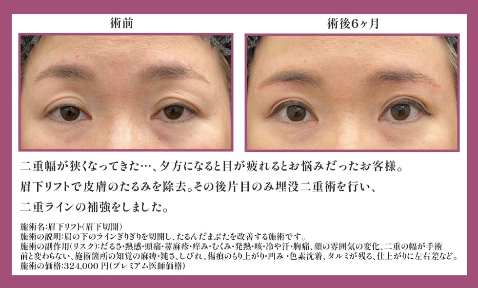 眉下リフト<br />
