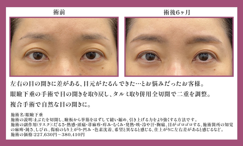 眼瞼下垂＋タルミ取り併用全切開<br />
